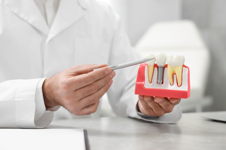 dental implants - featured image